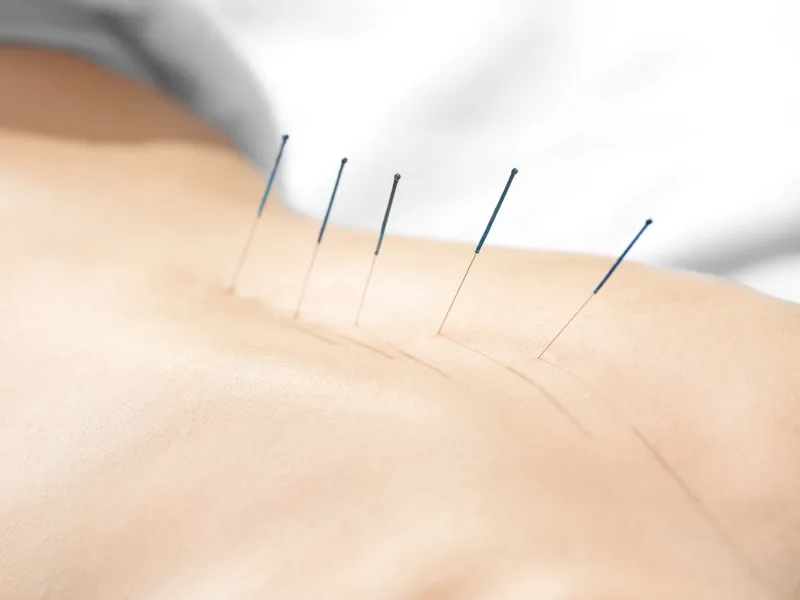 Acupuncture at Health & Healing Family Chiropractic in Andover