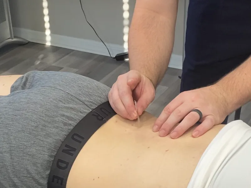 How Dry Needling works at Health & Healing Family Chiropractic