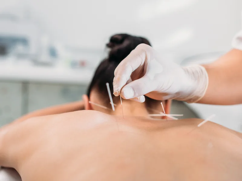 Dry Needling at Health & Healing Family Chiropractic in Andover